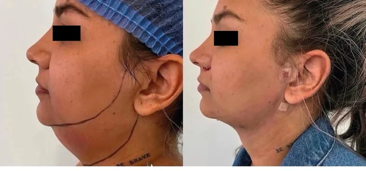 Antes y después de lipopapada en Bella Aura Quito