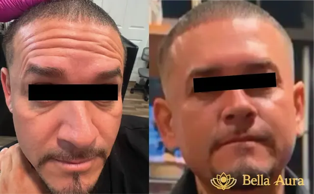 Antes y después de rejuvenecimiento facial con toxina botulínica y ácido hialurónico