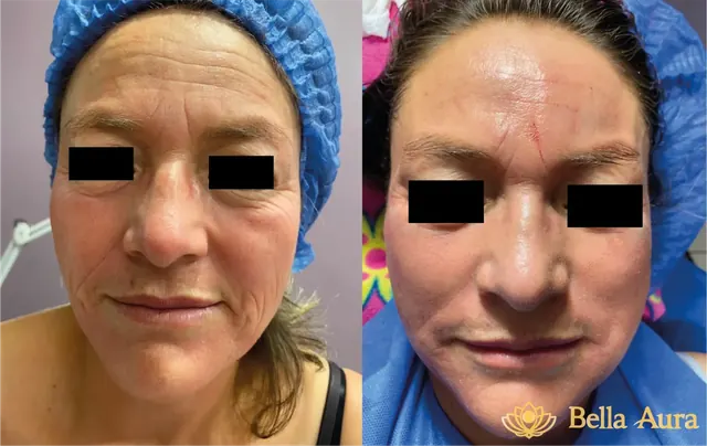 Antes y después de relleno facial con grasa y toxina botulínica